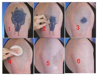 then laser tattoo removal