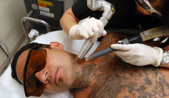 To laser tattoo removal, it must be time nano-seconds. enough energy for 
